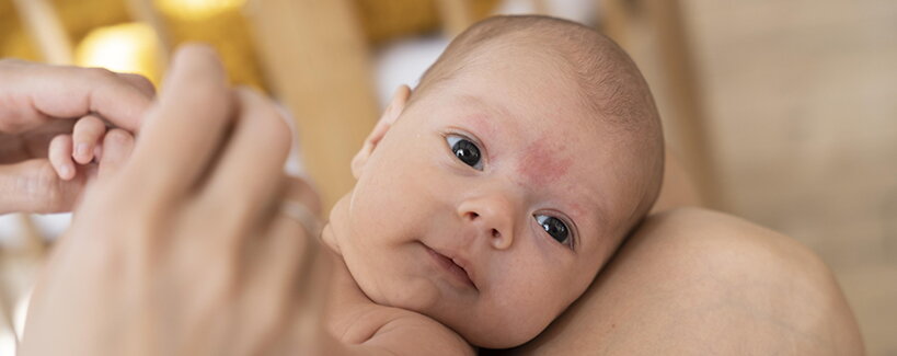 Novorozenecké akné: Proč vzniká a jak se ho zbavit?