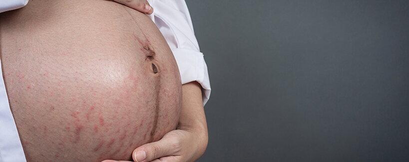 Strie po pôrode: Dá sa ich vôbec zbaviť?